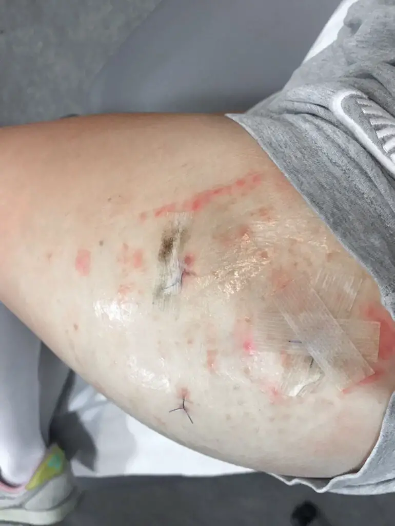 a skin reaction to the wound dressing following hip surgery