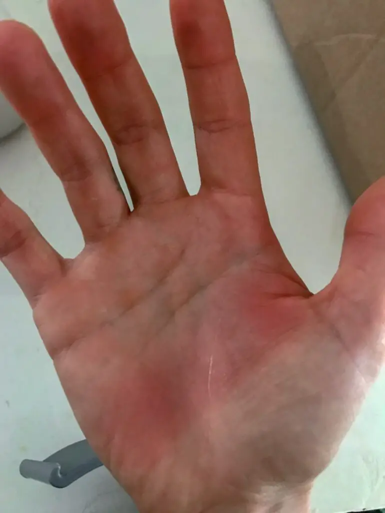 red mark on hand after using crutches