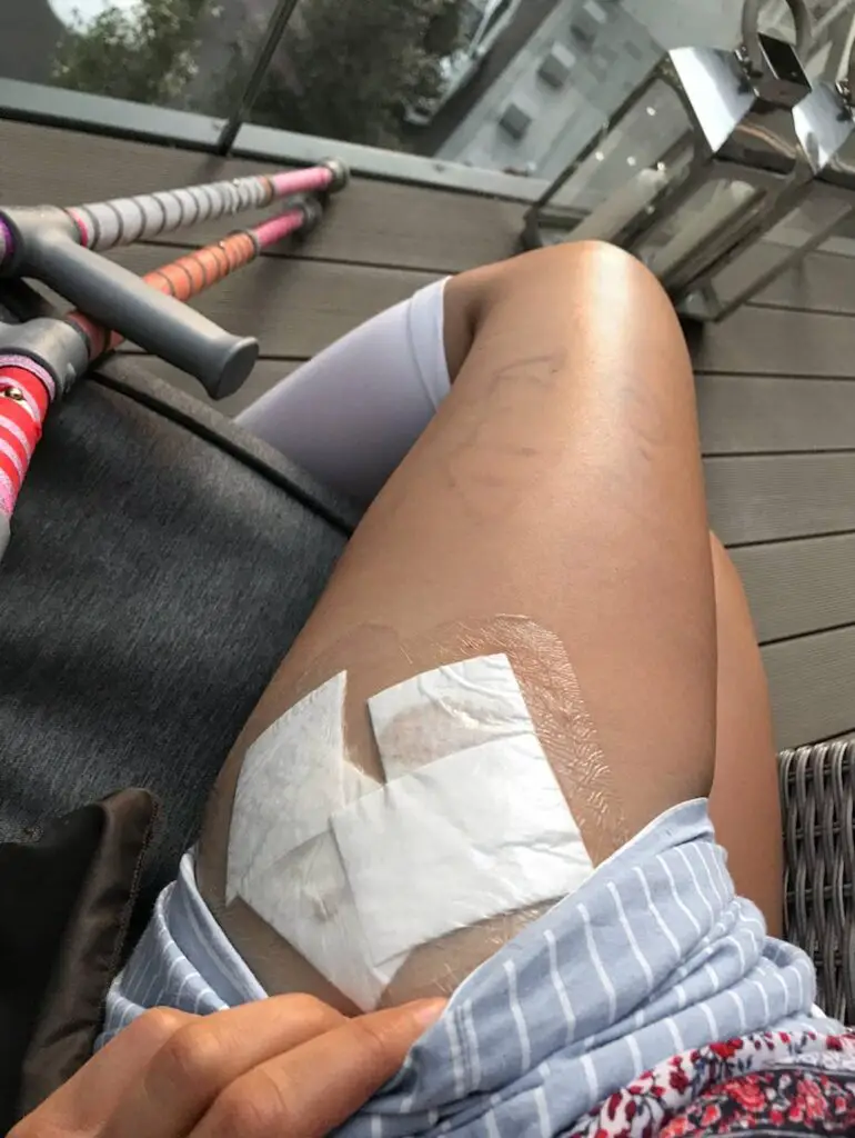 Zoes left leg with wound dressing taking a break from post op rehab