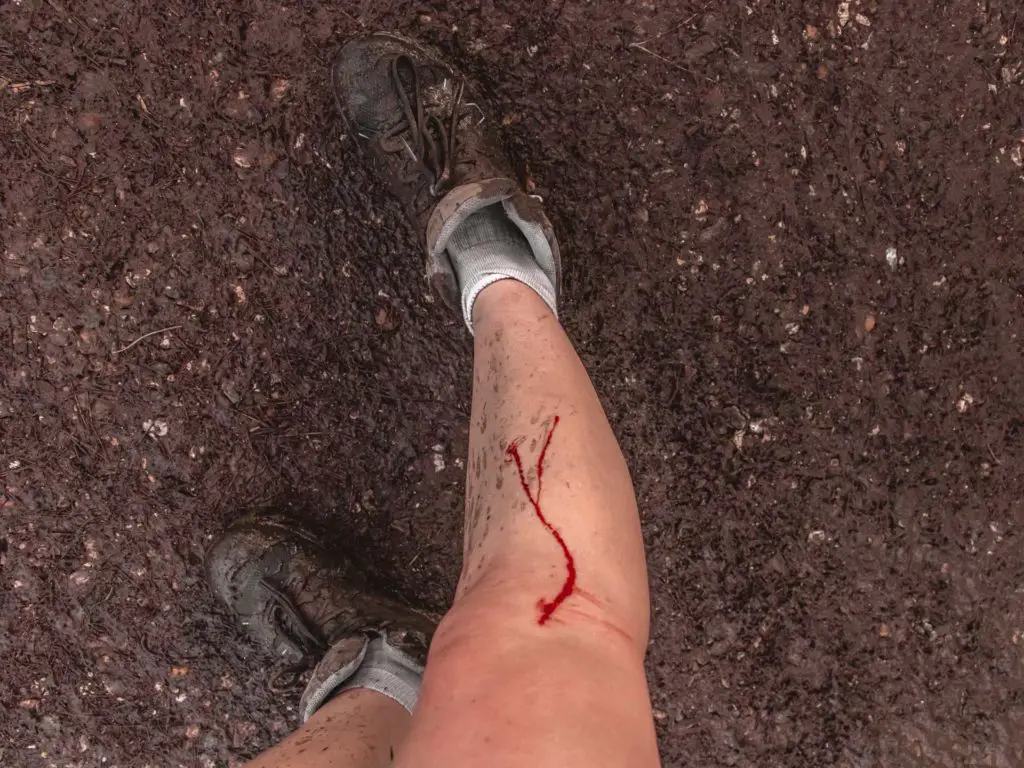 Zoe Tehrani cut leg whilst walking in the New Forest.